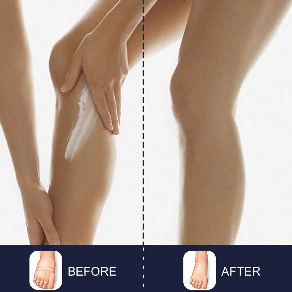 Anti Edema Foot Cream Foot Massage Health Care Cream Effective Alleviation Varicose Veins Arm Leg Swelling Pain Relaxing Cream