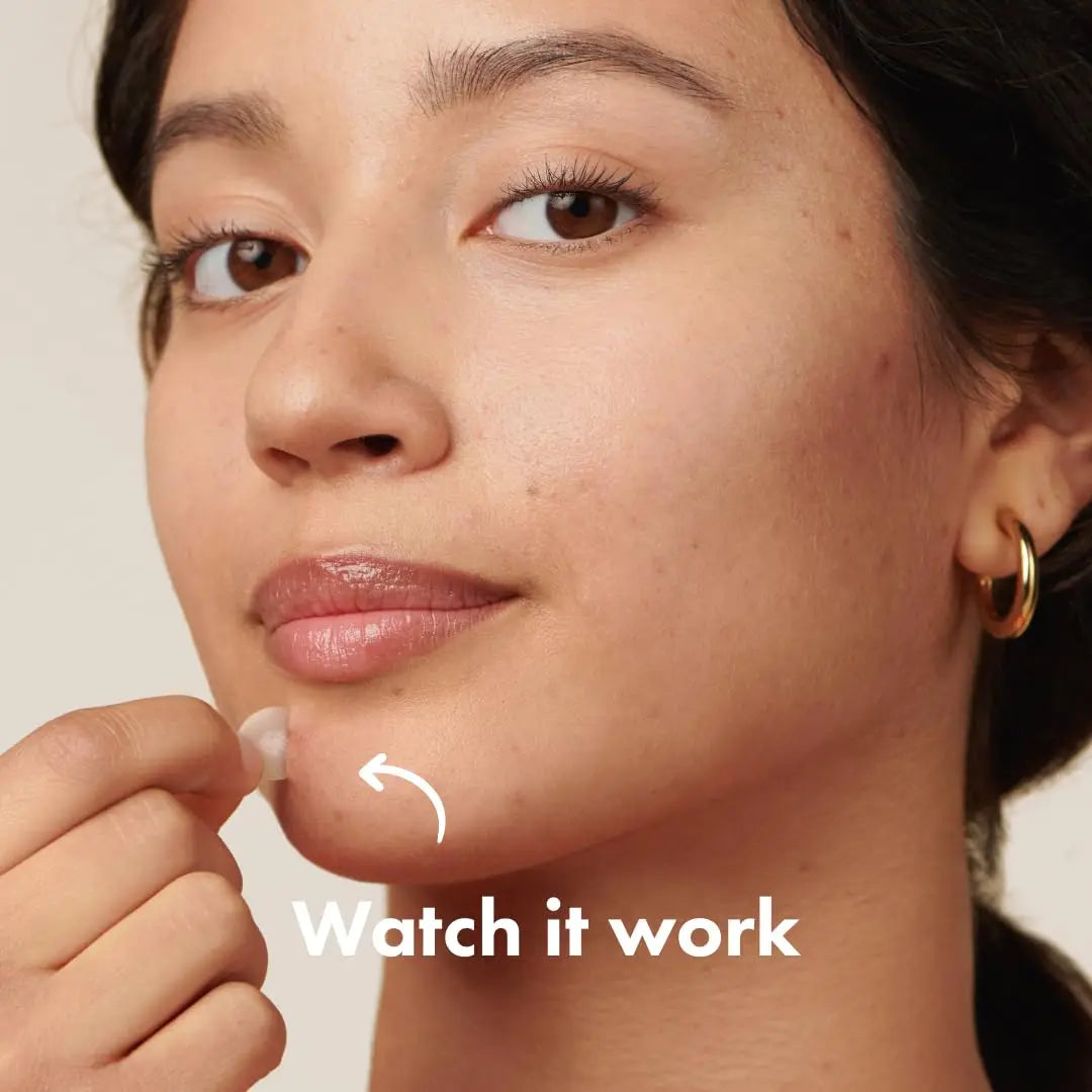 Mighty Patch from Hero Cosmetics is a hydrocolloid acne patch that covers facial acne and blemishes.